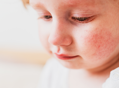 атопічна екзема