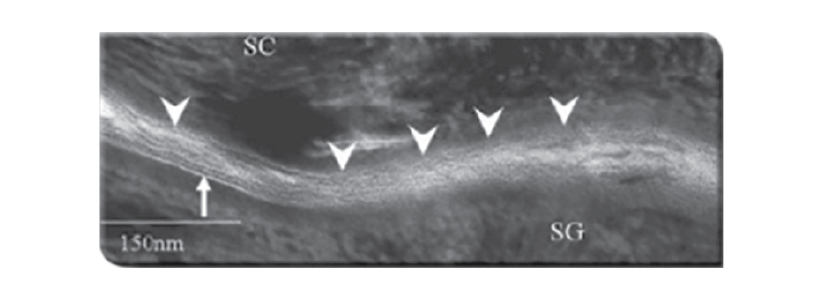 Лікування бетаметазоном - нормальна структура шкірного бар'єру відсутня
