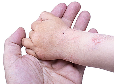 атопічний дерматит легкого ступеня